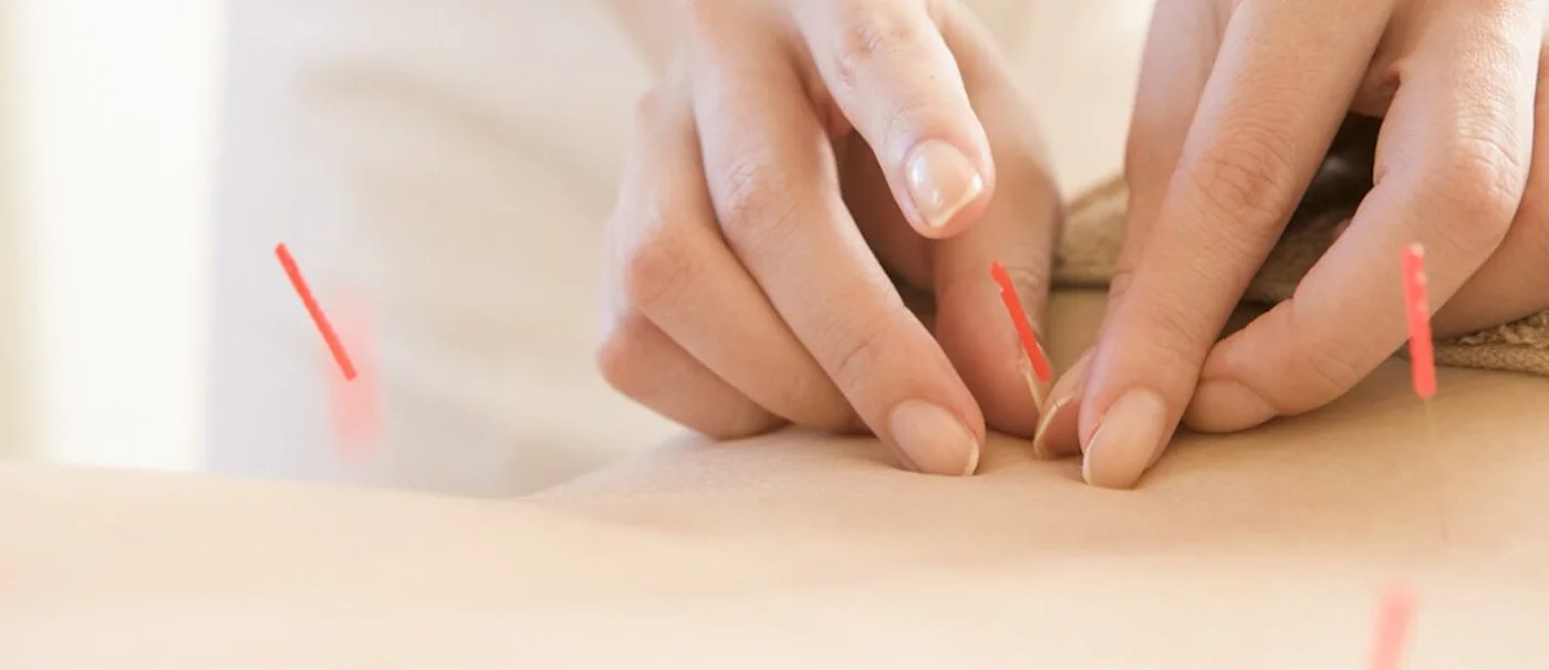 Akupunkturbehandlung